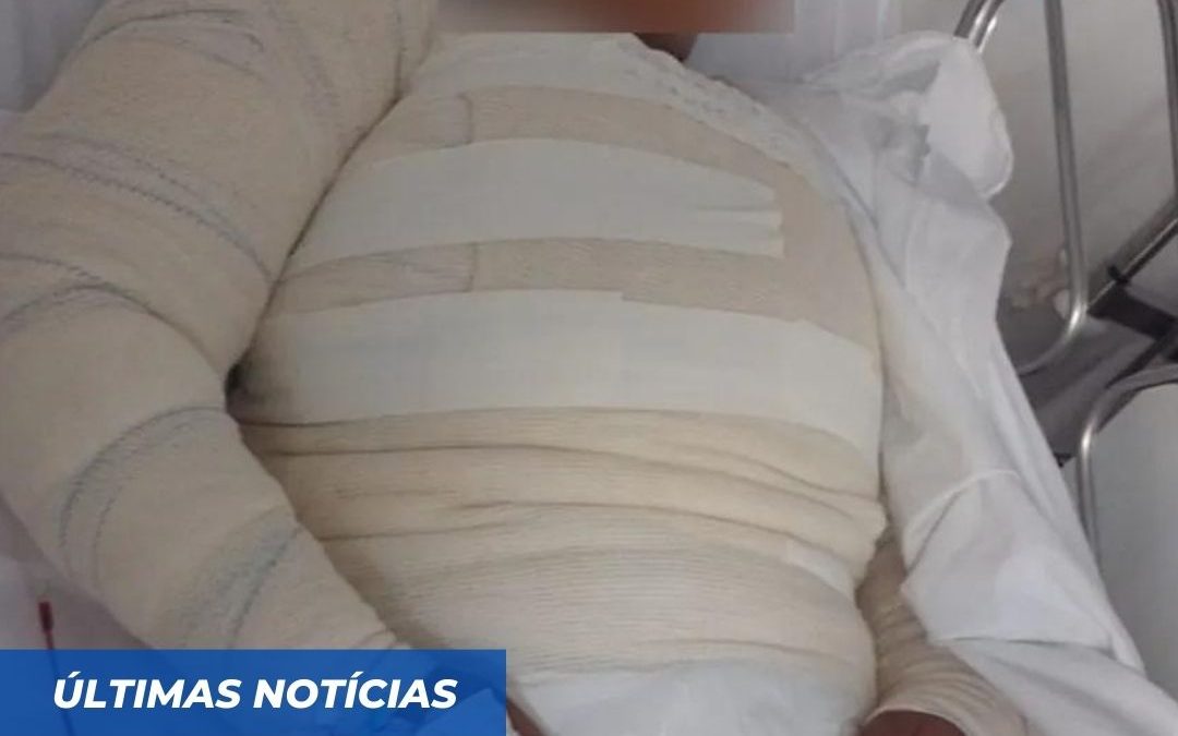 Mulher tem 50% do corpo queimado após ser atacada com água fervente em Santo Amaro; ex-companheiro é o principal suspeito