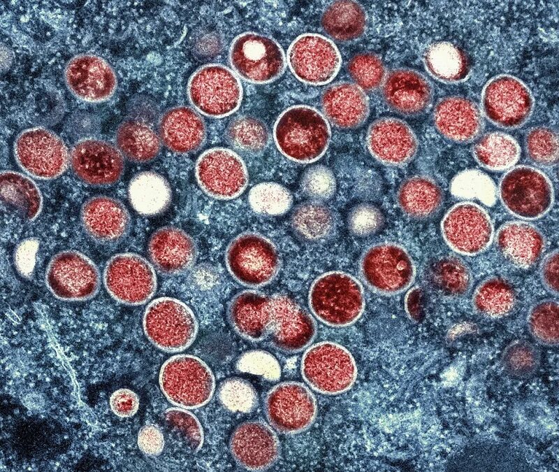 Brasil contabiliza 1,5 mil casos de mpox em 2024